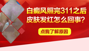 儿童脖颈有白点照UVB能治得好吗