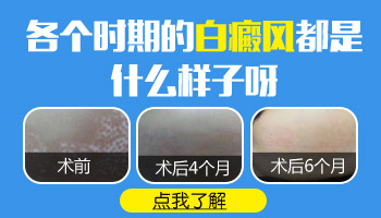 小孩身上出白块照308起泡了怎么办