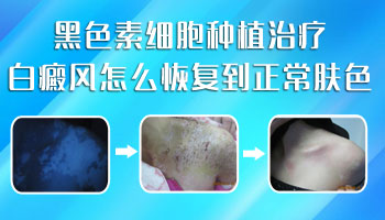 白癜风瓷白色照uvb多久能有效果