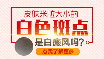 婴儿身上有大面积白斑只照uvb光能控制住吗