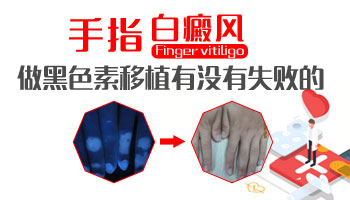 儿童腹部巴掌大白斑照308好还是uvb效果好
