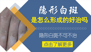 儿童额头巴掌大白斑哪种疗法适合