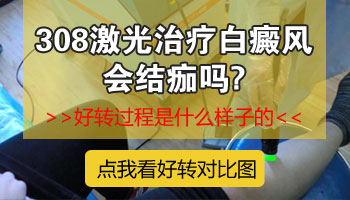 发展期白癜风不吃药能治疗好吗，用什么仪器