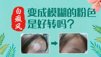 儿童面部有片白一天照几次激光比较合适
