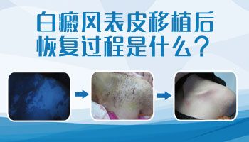 儿童胸部长白癜风做308激光照多长时间合适