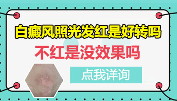 儿童脖颈有白点照UVB能治得好吗