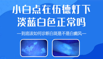 小孩身上有片白照UVB能治得好吗