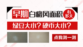 小孩身上有白斑照308激光能治好吗