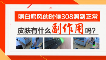 婴儿身上有黄豆大白癜风照UVB能治得好吗