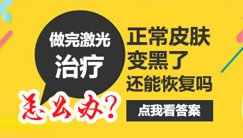 儿童额头长白癜风做308激光照多长时间合适