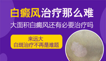 小孩身上有大面积白斑抹药膏效果怎么样