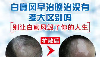 孩子身上有白块在扩散该怎么办
