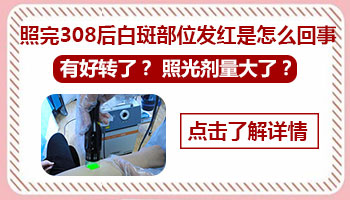 小孩身上有黄豆大白癜风照308激光多长久有好转